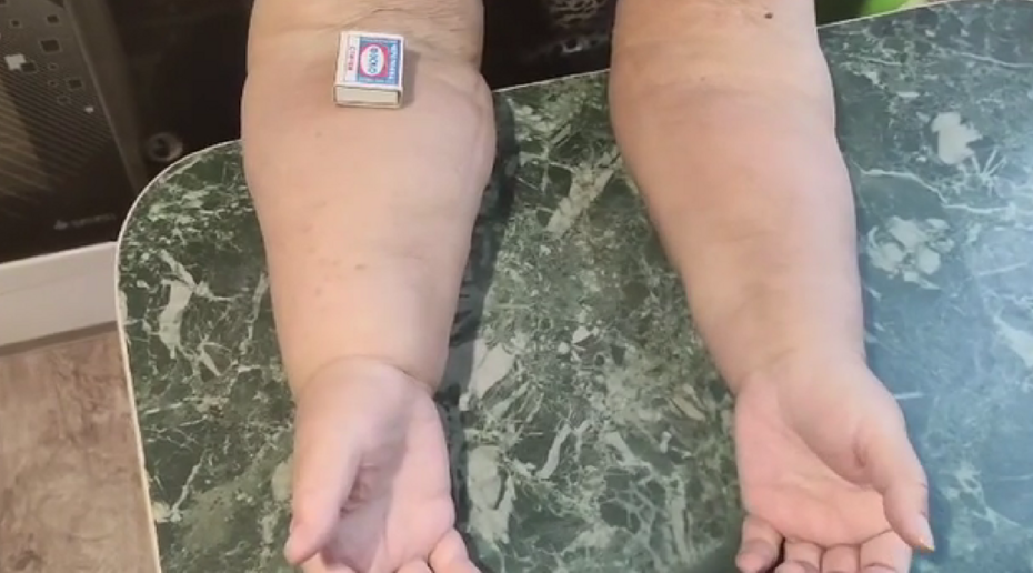 У перенесшей рак россиянки распухли руки: семья жалуется на отсутствие лечения