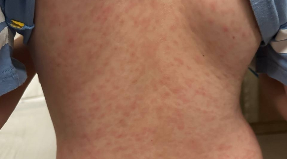 На Бали вспышка кори в международной школе: пострадали российские дети