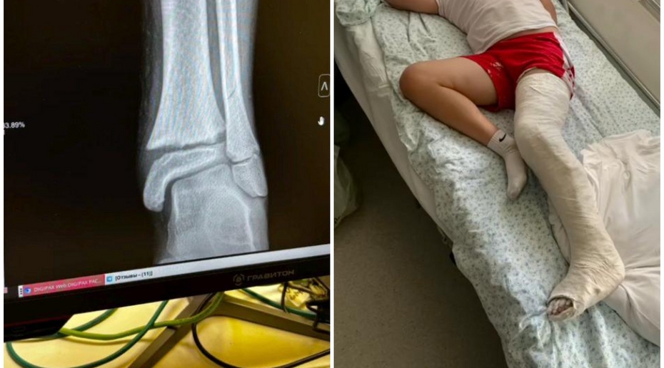 Подмосковный школьник получил перелом ноги при отработке приема самбо «Ахилл»