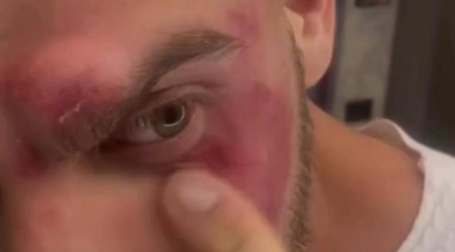 Подмосковный фитнес-тренер уронил себе на лицо штангу весом больше 100 кг